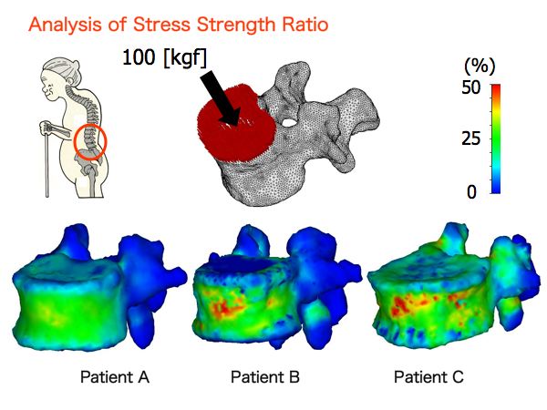 A study on patient-specific modeling and mechanical analysis of bone