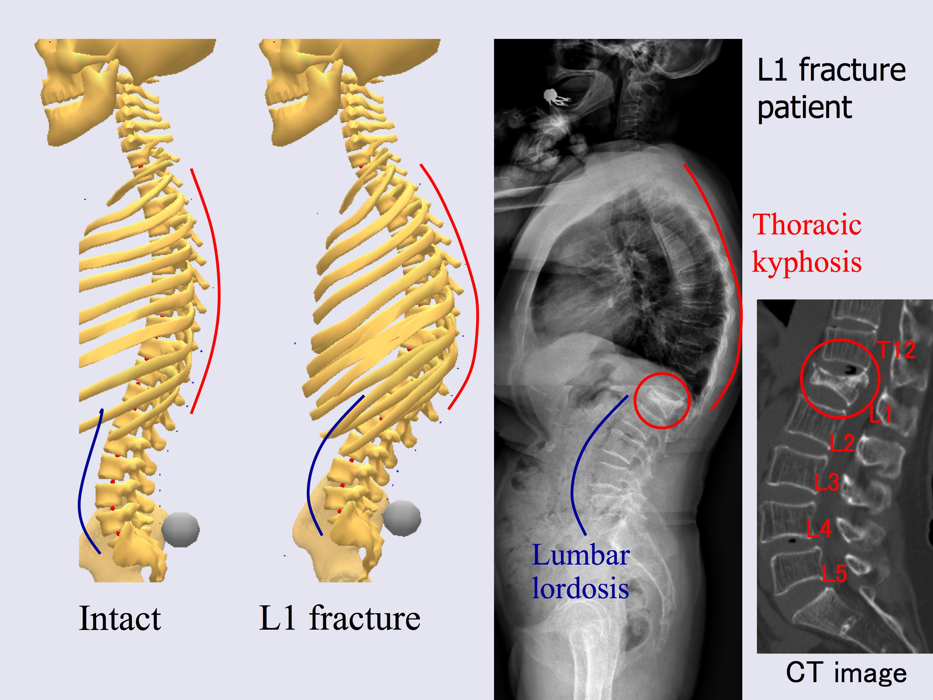 A study on biomechanics of musculoskeletal system on spine